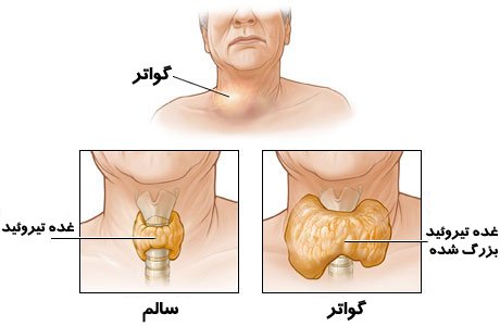 Paper the role of nutrition in disease goiter