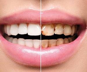 پوسیدگی دندان این عادت اشتباه دلیل پوسیدگی دندان شماست!
